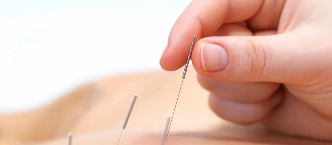 Premier acupuncture care — Acupuncture in Mission Viejo, CA